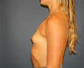 Feel Beautiful - breast augment 400cc - Before Photo